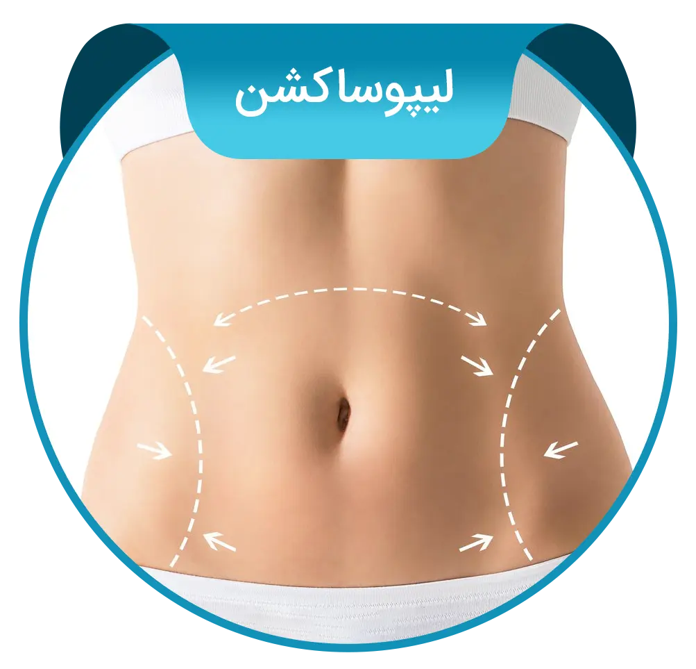 liposuction-fa