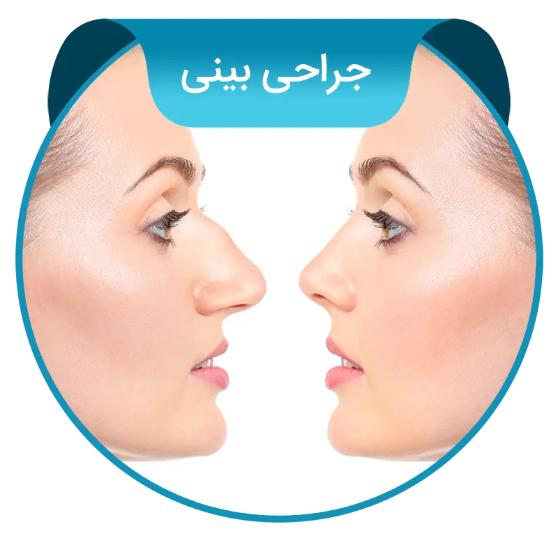 rhinoplasty-fa