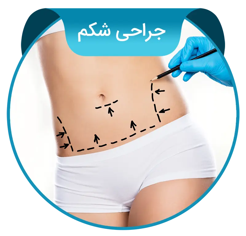 tummy-tuck-fa جراحی شکم